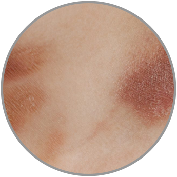 Eczema Treatment in Crest Hill & Naperville | Premier Dermatology