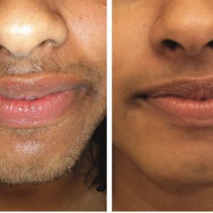 laser hair removal facial hair