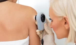 Different Types of Moles