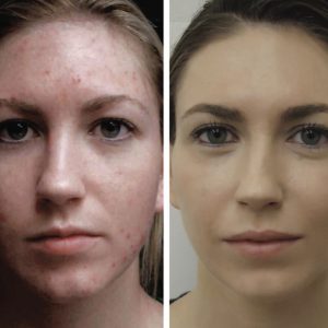 what is laser treatment for acne scars