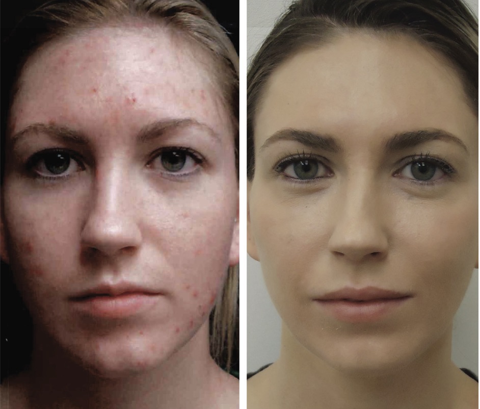 Laser Treatment For Acne & Acne Scars in Crest Hill & Naperville