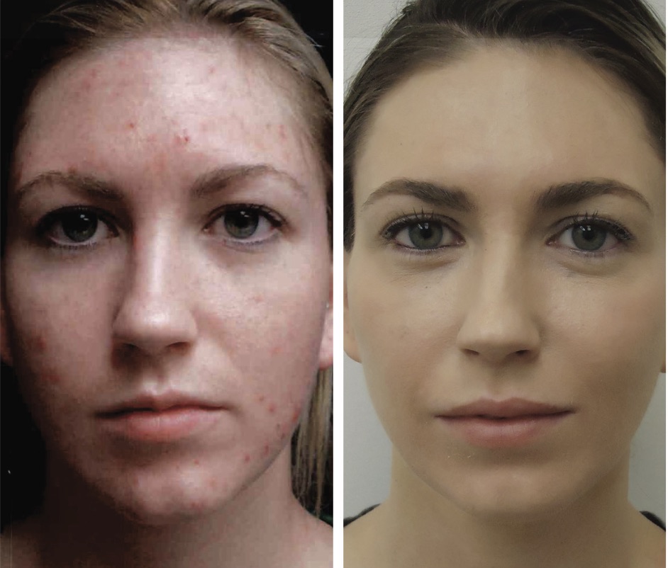 Laser Treatment For Acne And Acne Scars In Crest Hill And Naperville Premier Dermatology