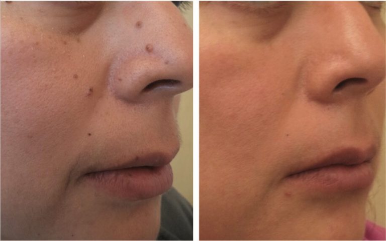 Laser treatment for skin lesions | Premier Dermatology