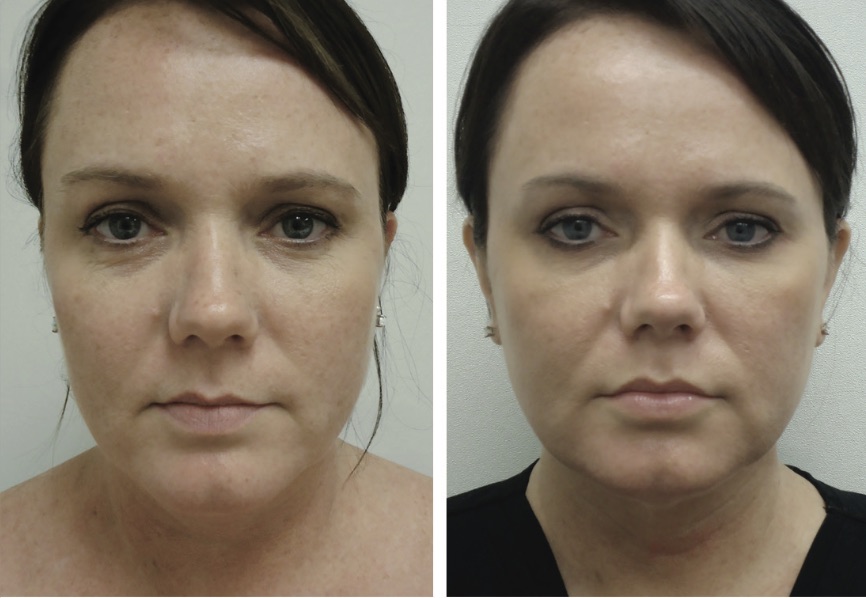 Thermage® Skin Tightening By Dermatologists In Crest Hill And Naperville