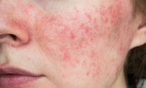 Skin with Rosacea