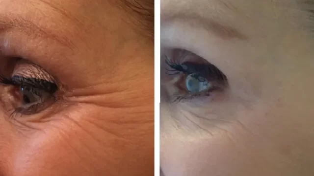 service-treatment-after-placeholder