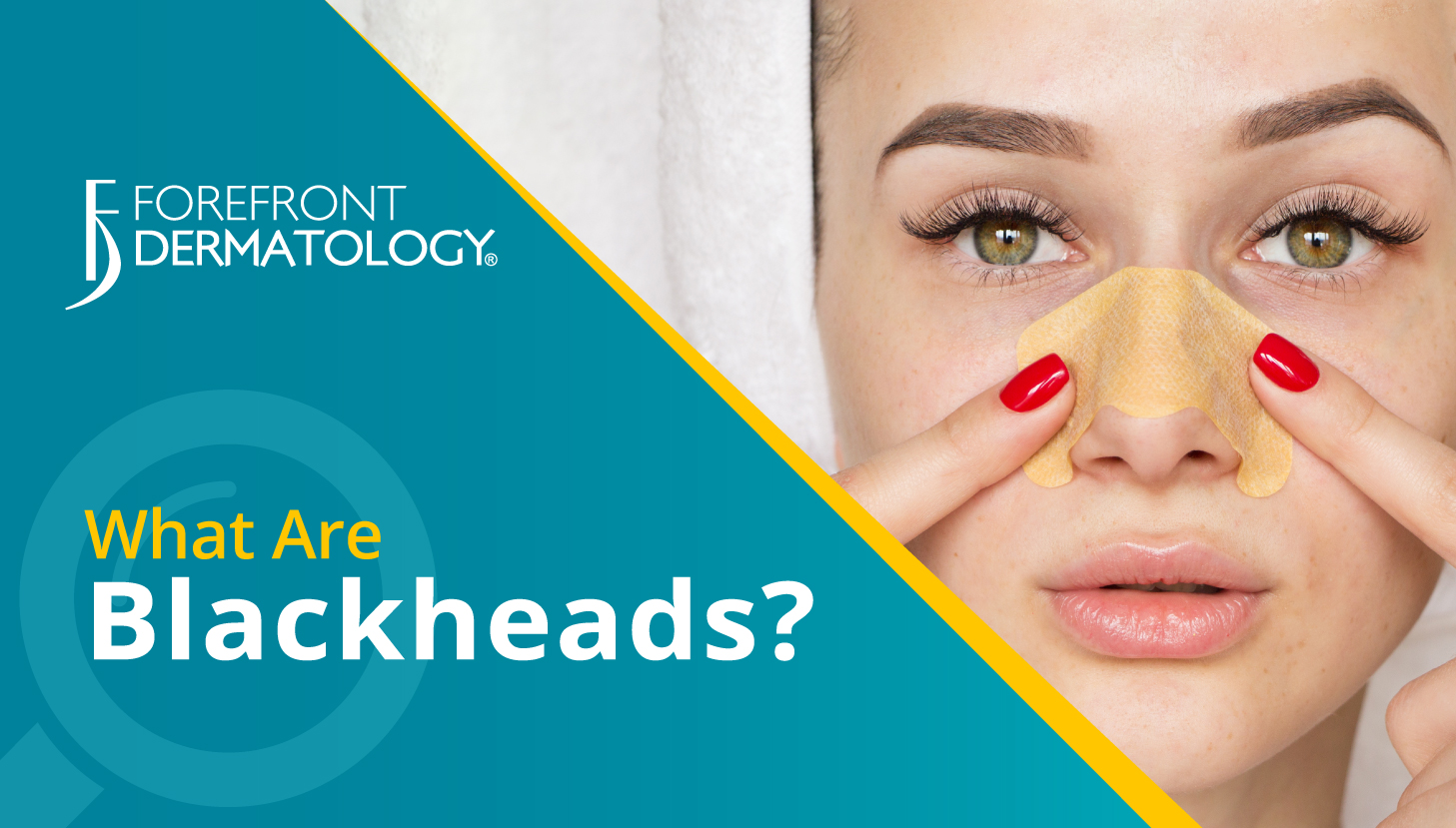 what-are-blackheads-premier-dermatology